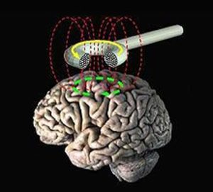 220px-Transcranial_magnetic_stimulation-2
